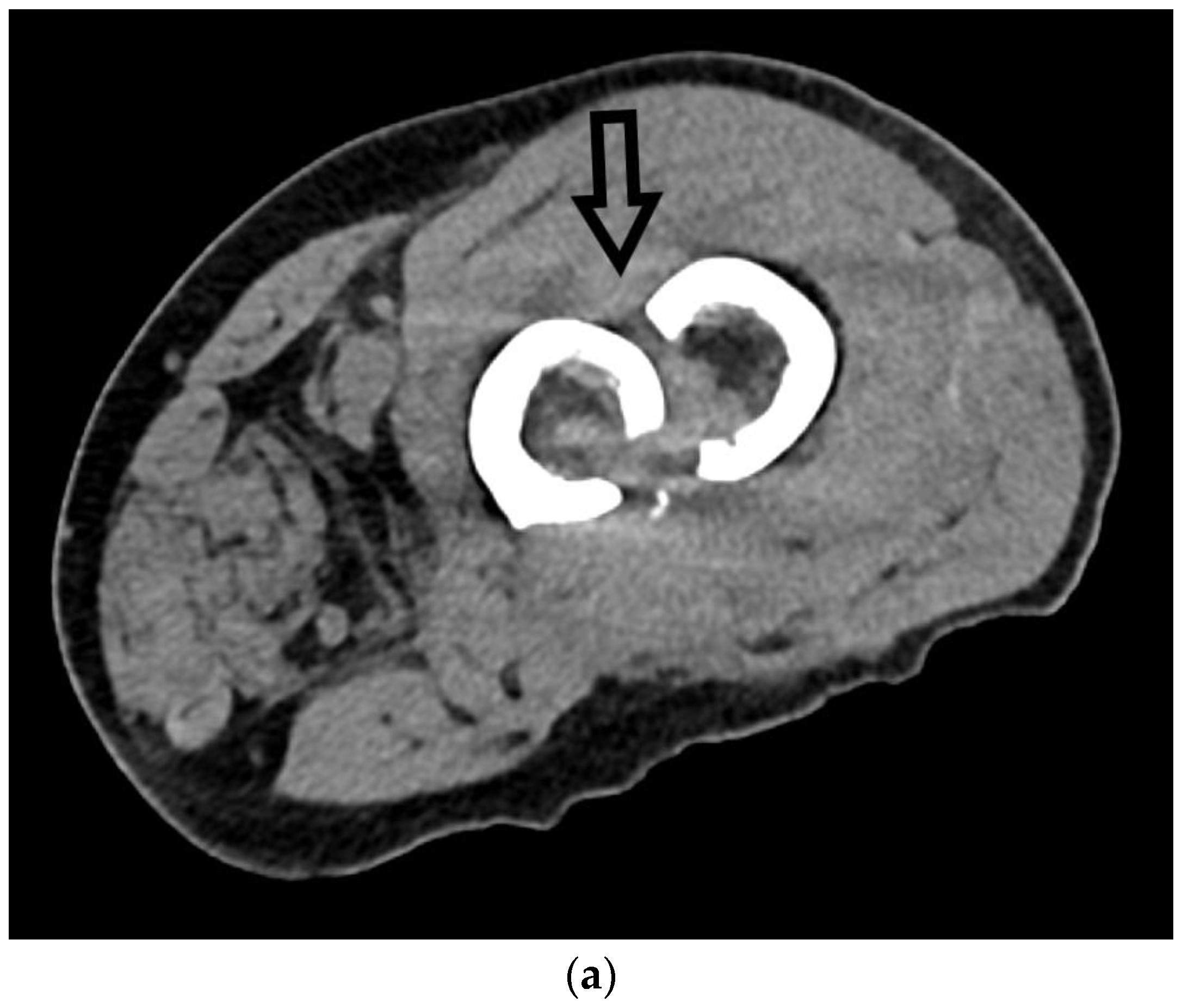Radiological Diagnosis and Imaging of Femoral Shaft Fractures | MDPI