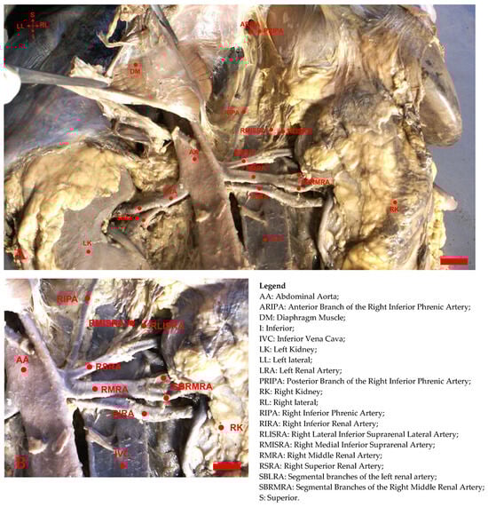 (A) Posterior view of the Triple RA and anomalous origin of the IPA. Scale Bar: 2.0 cm. (B) Higher magnification. Scale Bar: 0.5 cm. Note: In Figure 1, all abbreviations include an ‘R’ (Right) or ‘L’ (Left) prefix to denote the specific side of the bilateral structure shown in the diagram. The base abbreviations (e.g., RA, MRA) are consistent with the main text.