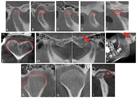 Condyle osseous changes. (A): flattening, (B): sclerosis, (C): erosion, (D): osteophyte, (E): subchondral cyst, (F): bifid condyle, (G1): normal condyle, (G2): reed shape, (H): ankylosis, (I1): pole depression, (I2): normal condyle (J): joint mouse.