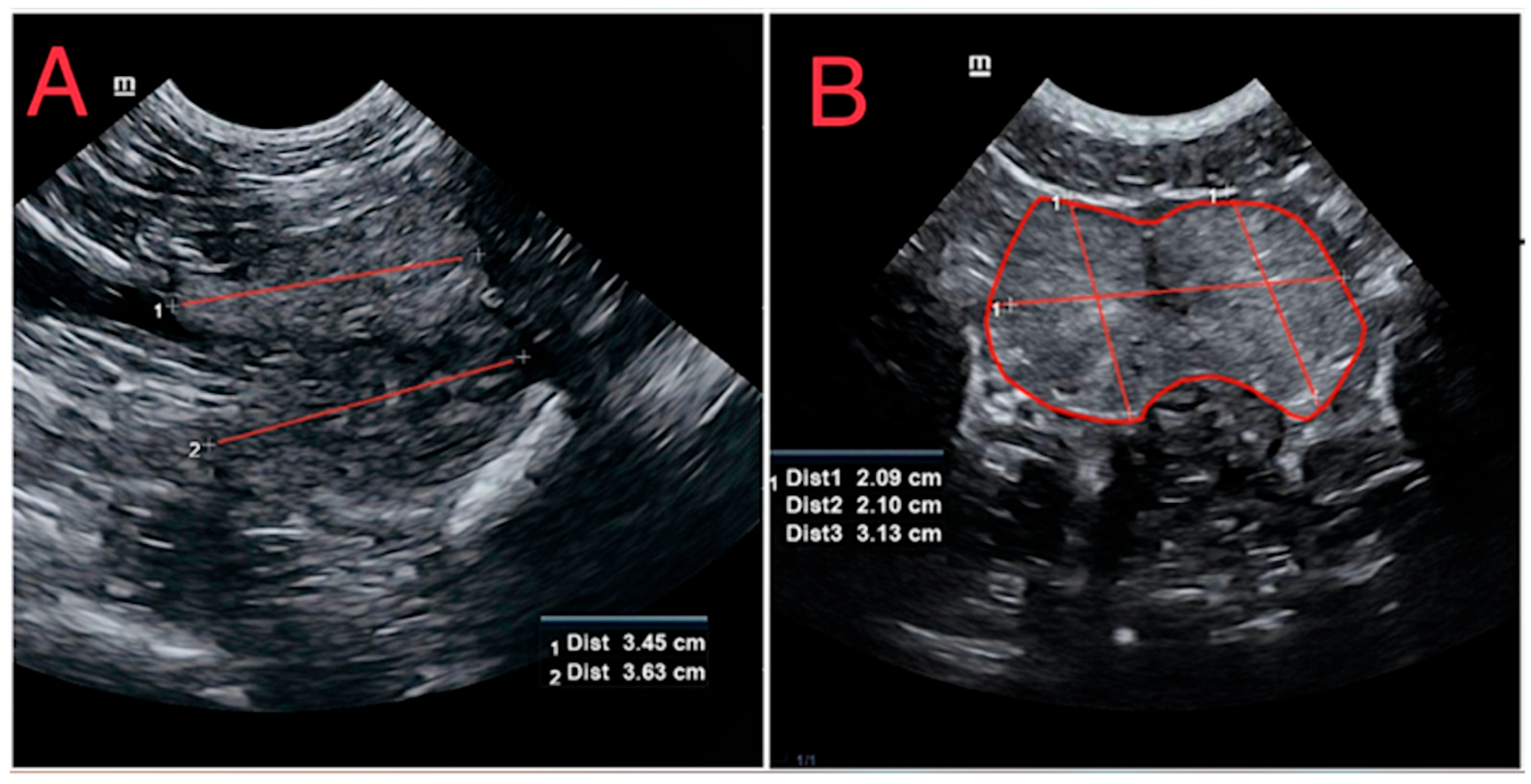 Normal Prostate Dimensions Comparative Evaluation of Diagnostic Methods for Subclinical Benign ...