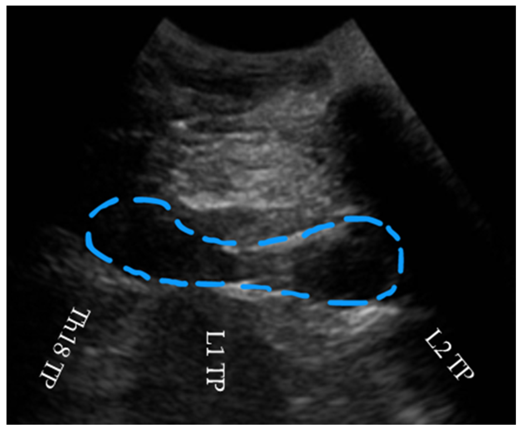 Tps Injection An Ultrasound-Guided Thoracolumbar Erector Spinae Plane Block: An ...
