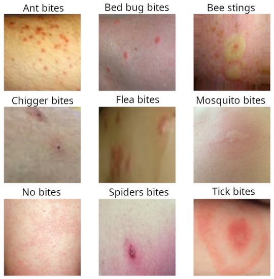 Deep Learning Methods for Bug Bite Classification: An End-to-End System ...