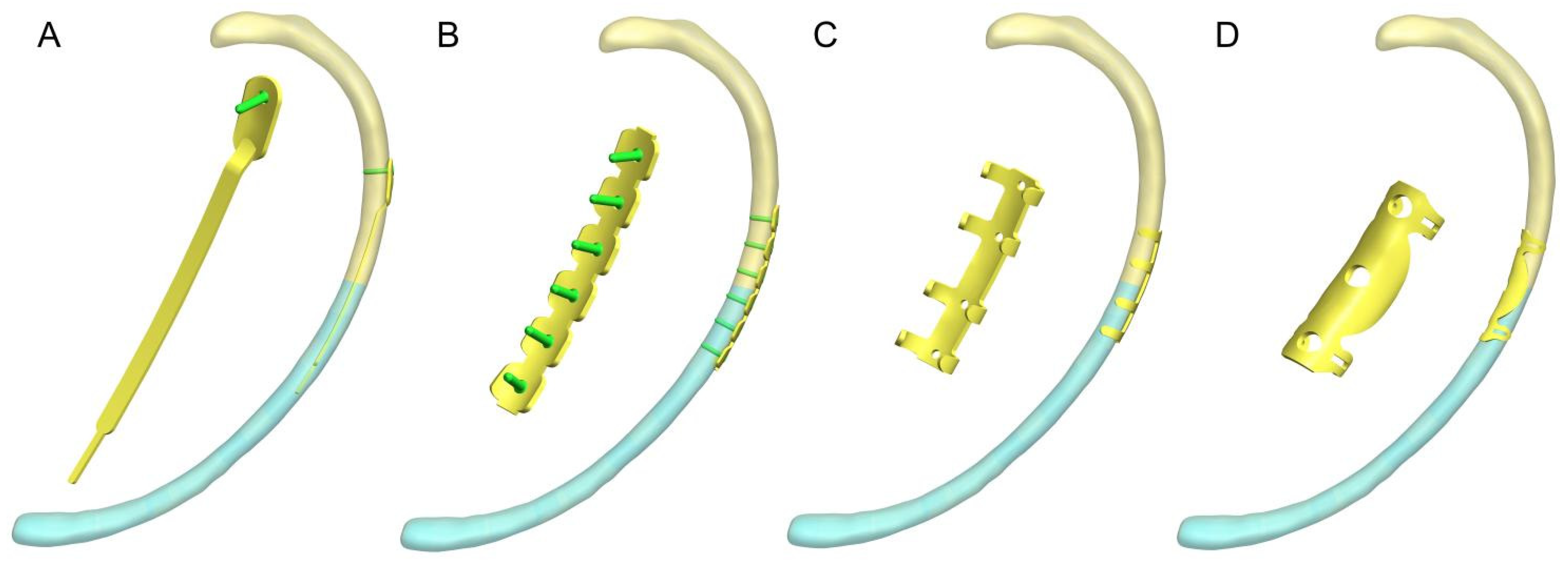 Lateral Cortical Fixation as the Optimal Strategy for Achieving ...