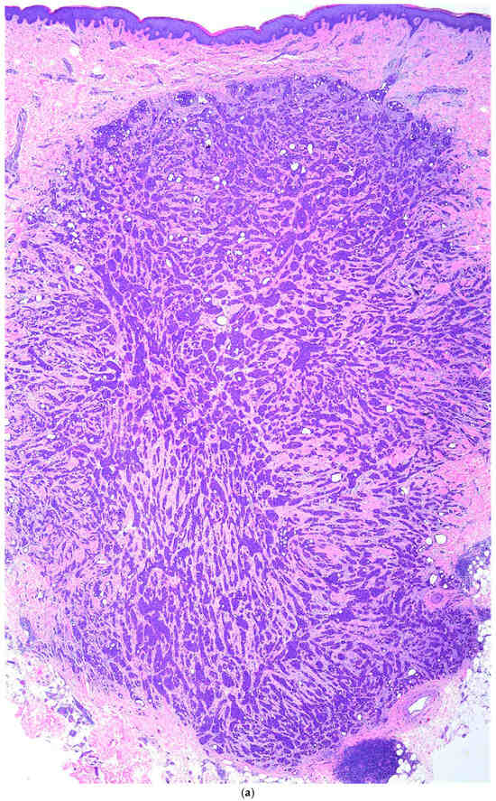 (a). Hematoxylin and eosin staining for primary cutaneous cribriform apocrine carcinoma at 20× magnification. A nodular, well-circumscribed, nonencapsulated, pandermal tumor with a border abutting the underlying subcutaneous tissue, without connection to the overlying epidermis or adnexal structures, and a desmoplastic stroma is demonstrated. Lymphoid aggregates are appreciated in the periphery. (b) Hematoxylin and eosin staining for primary cutaneous cribriform apocrine carcinoma at 40× magnification. Characteristic anastomosing solid and cribriform nests, tubules, and cords of mildly atypical epithelial cells with eosinophilic cytoplasm and formation of glandular lumina. (c) Hematoxylin and eosin staining for primary cutaneous cribriform apocrine carcinoma at 200× magnification. Intratumoral lumina were characterized by size variations, attenuation of the surrounding epithelium, narrow anastomosing intraluminal bridges, and occasional micropapillary projections. (d) Hematoxylin and eosin staining for primary cutaneous cribriform apocrine carcinoma at 400× magnification. Mildly atypical cells with round or oval, hyperchromatic, basophilic, pleomorphic nuclei.