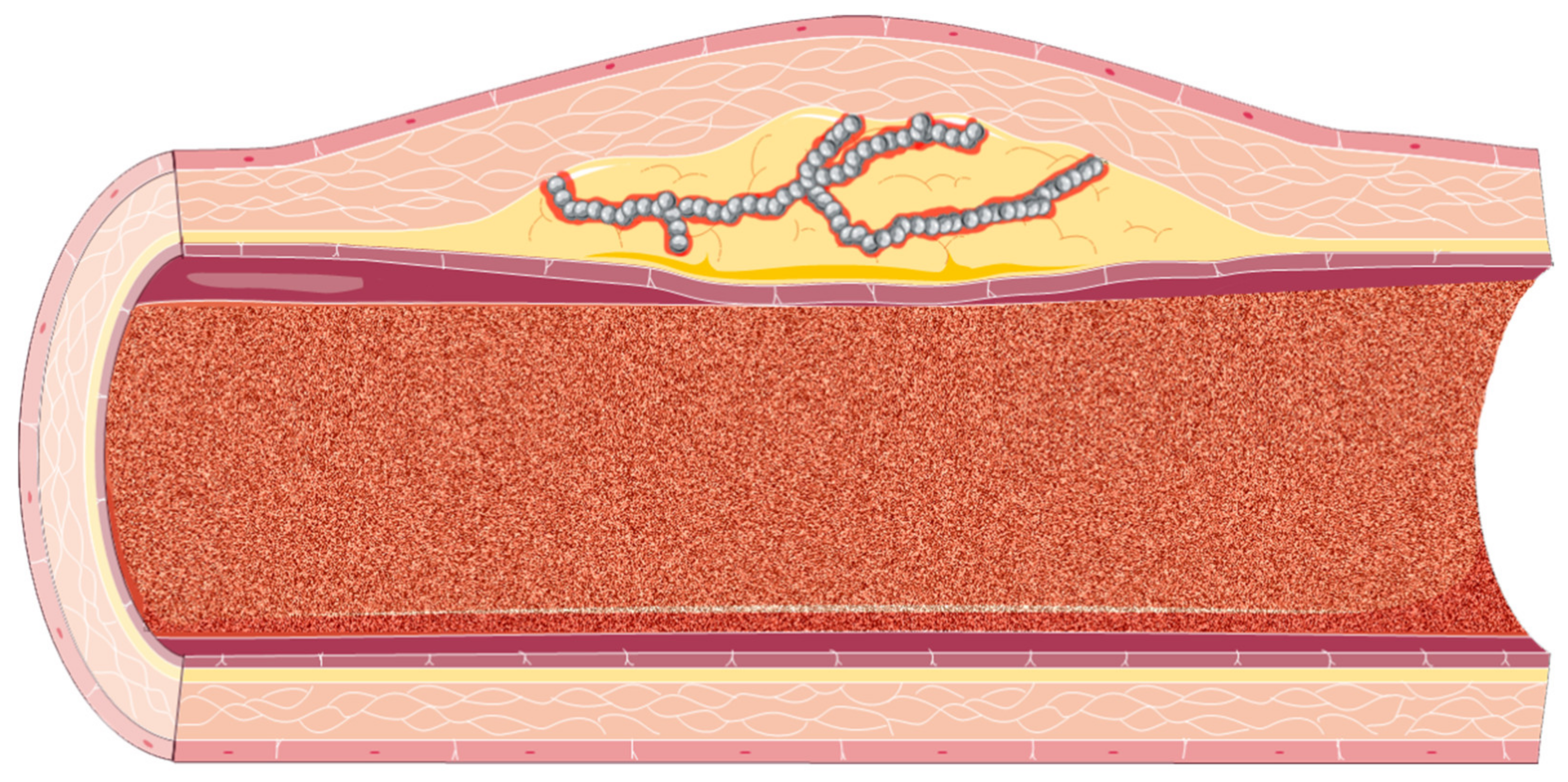 Ultrasound Methods in the Evaluation of Atherosclerosis: From ...