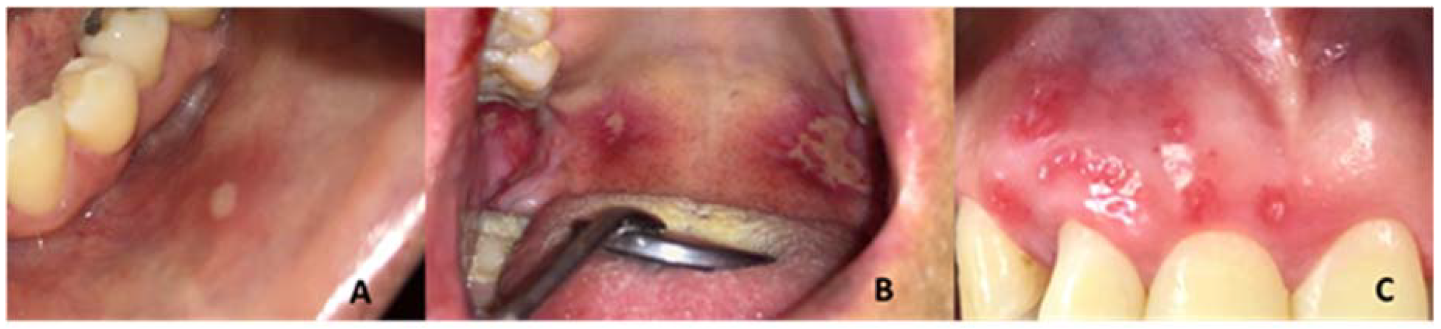 Major Ras Healing of Recurrent Aphthous Stomatitis by Non-Thermal Plasma: Pilot ...