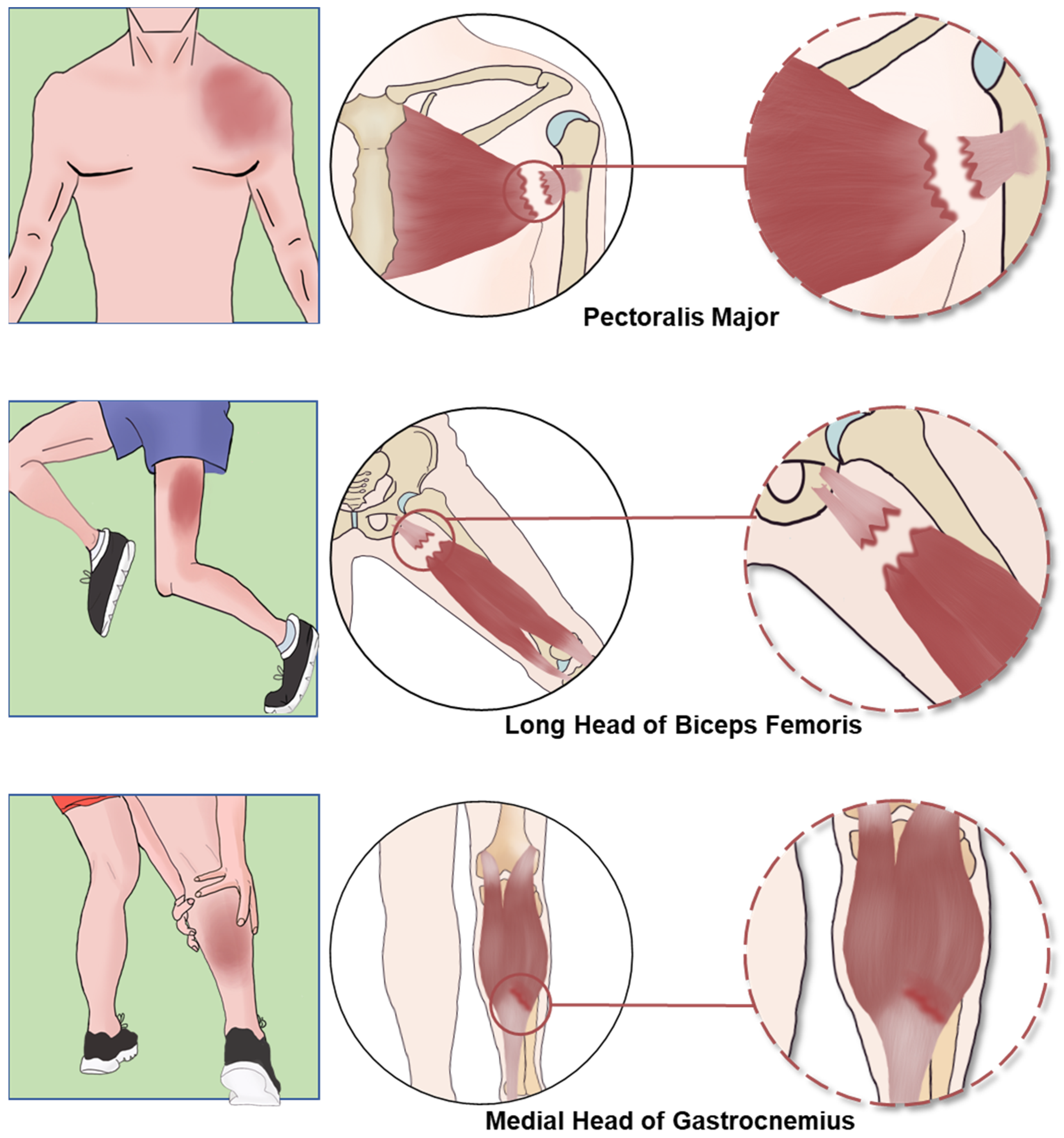 Greater Multangular Joint A Comprehensive Review of Muscle–Tendon Junction: Structure, Function ...