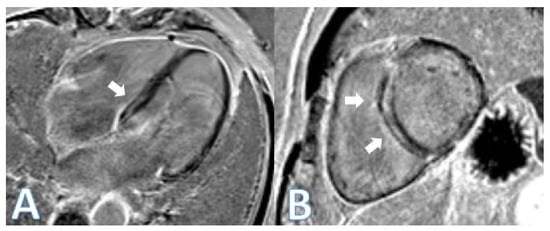 Wavy Wall Cladding Pattern Dilated Cardiomyopathy: From Genetics to Cardiac MRI