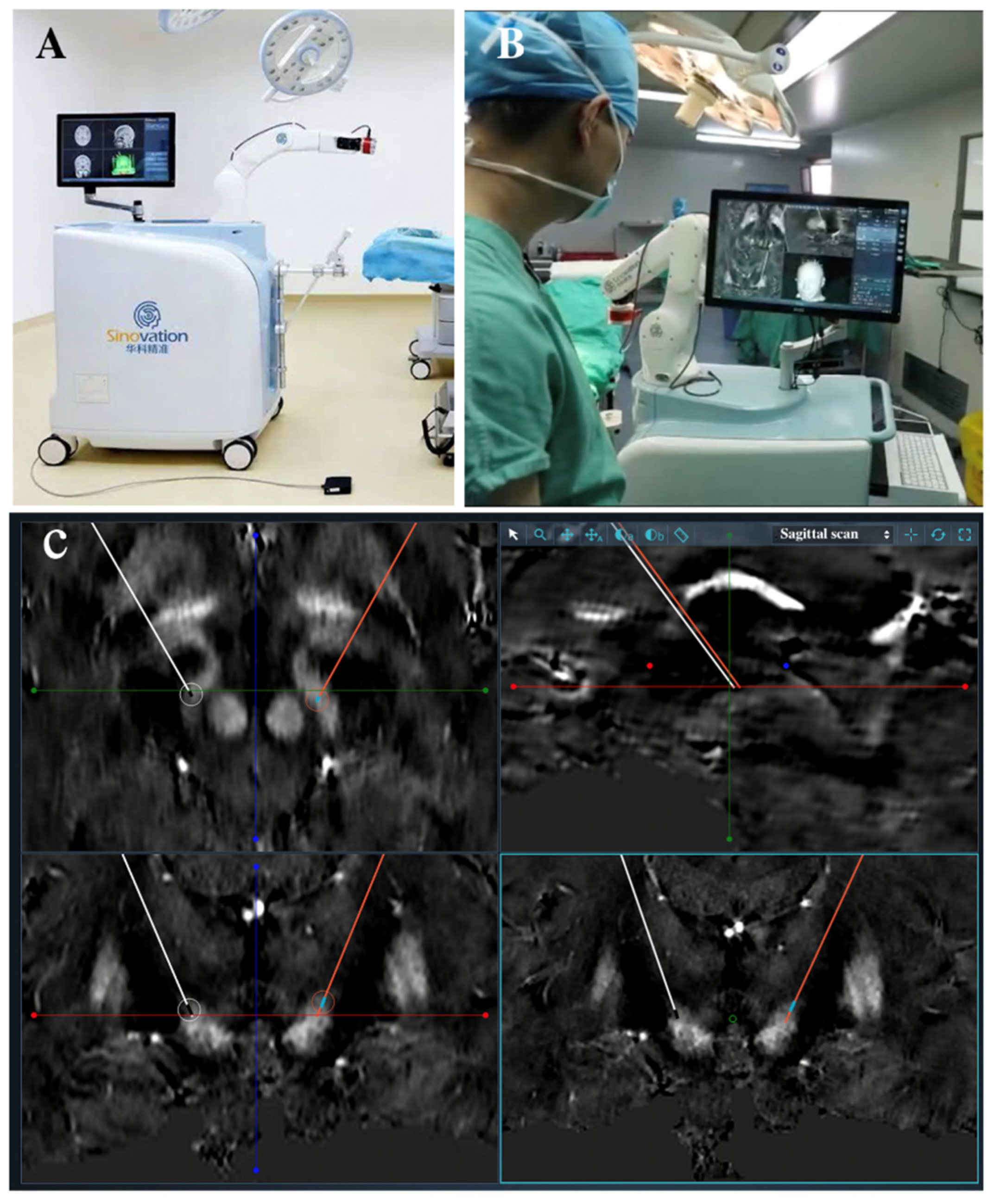 Techniques of Frameless Robot-Assisted Deep Brain Stimulation and ...