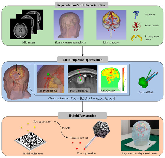 Workflow of the AR navigation system for stereotactic brain biopsy.