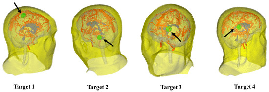 Four common locations (in green) of brain tumors used during evaluation.