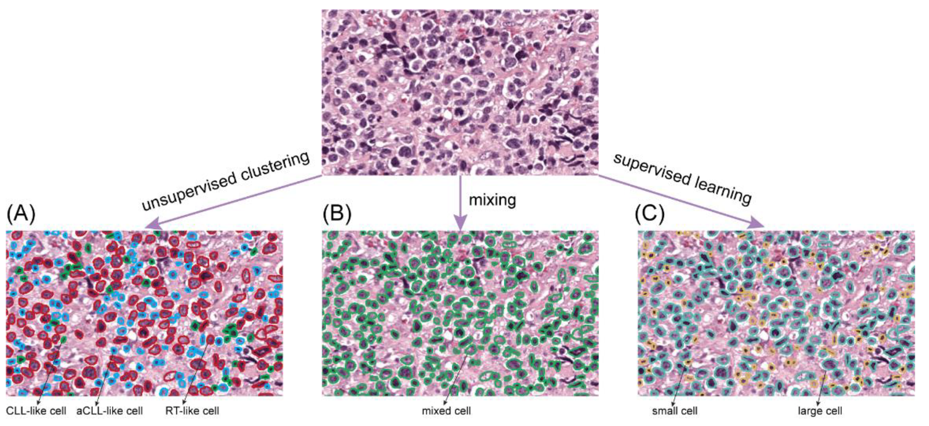 Chronic Lymphocytic Leukemia Progression Diagnosis with Intrinsic ...