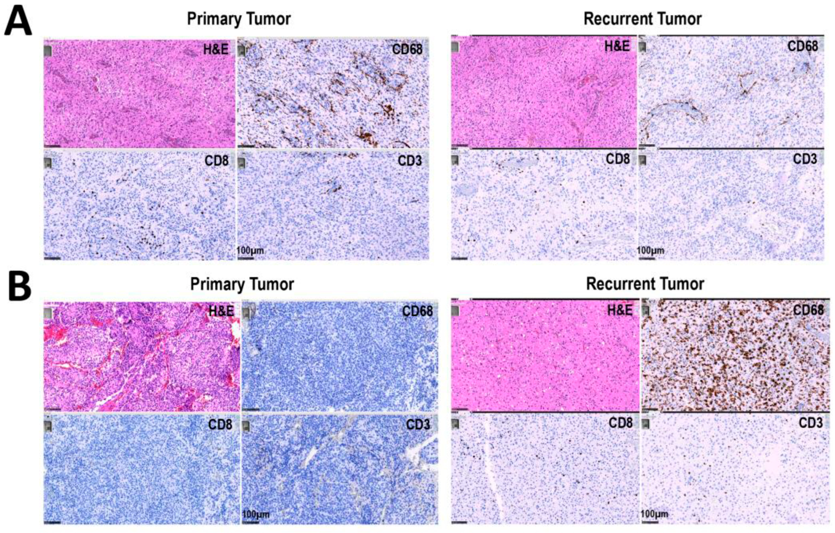 Spatial Distribution of Immune Cells in Primary and Recurrent ...
