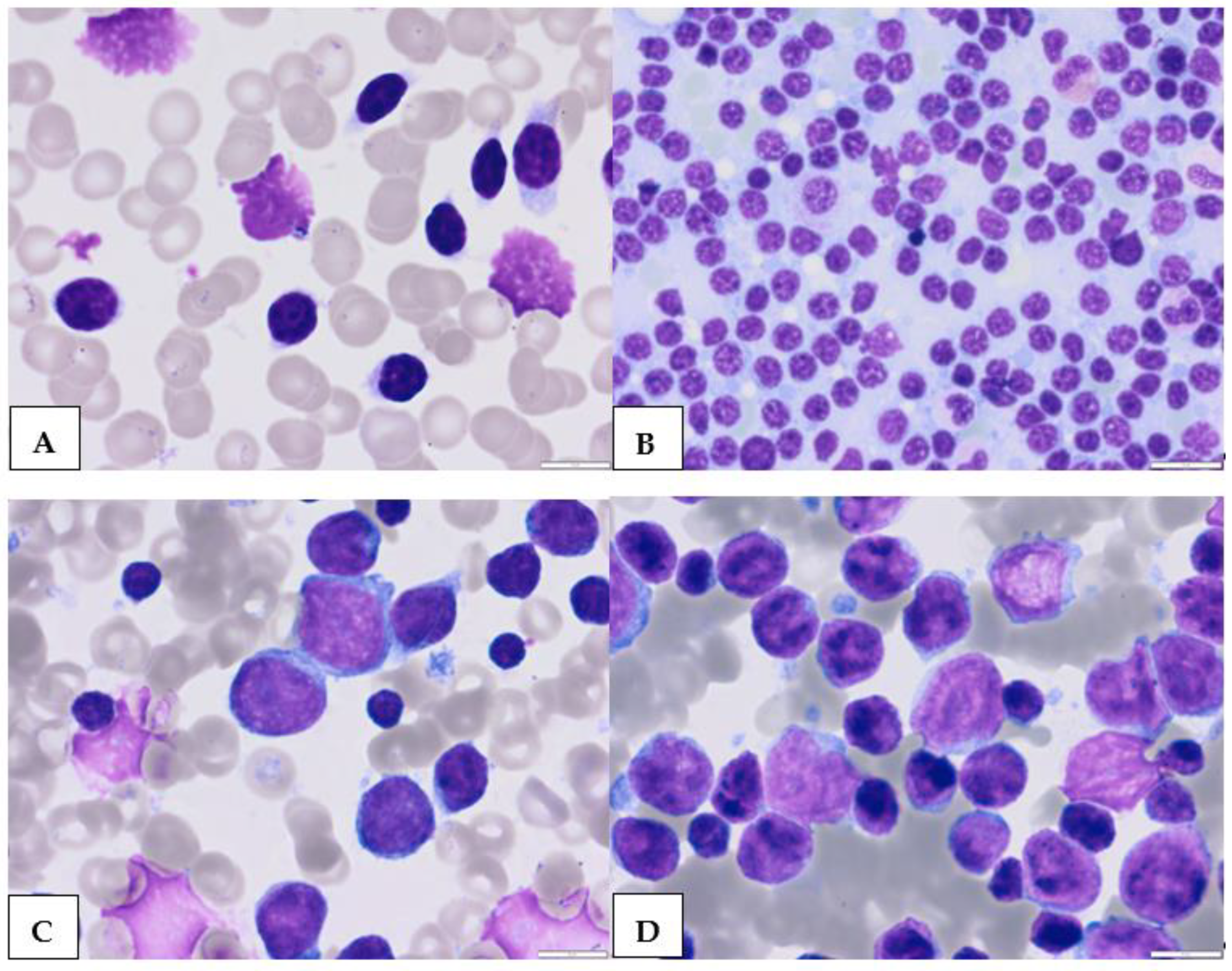 Atypical Chronic Lymphocytic Leukemia—The Current Status | MDPI