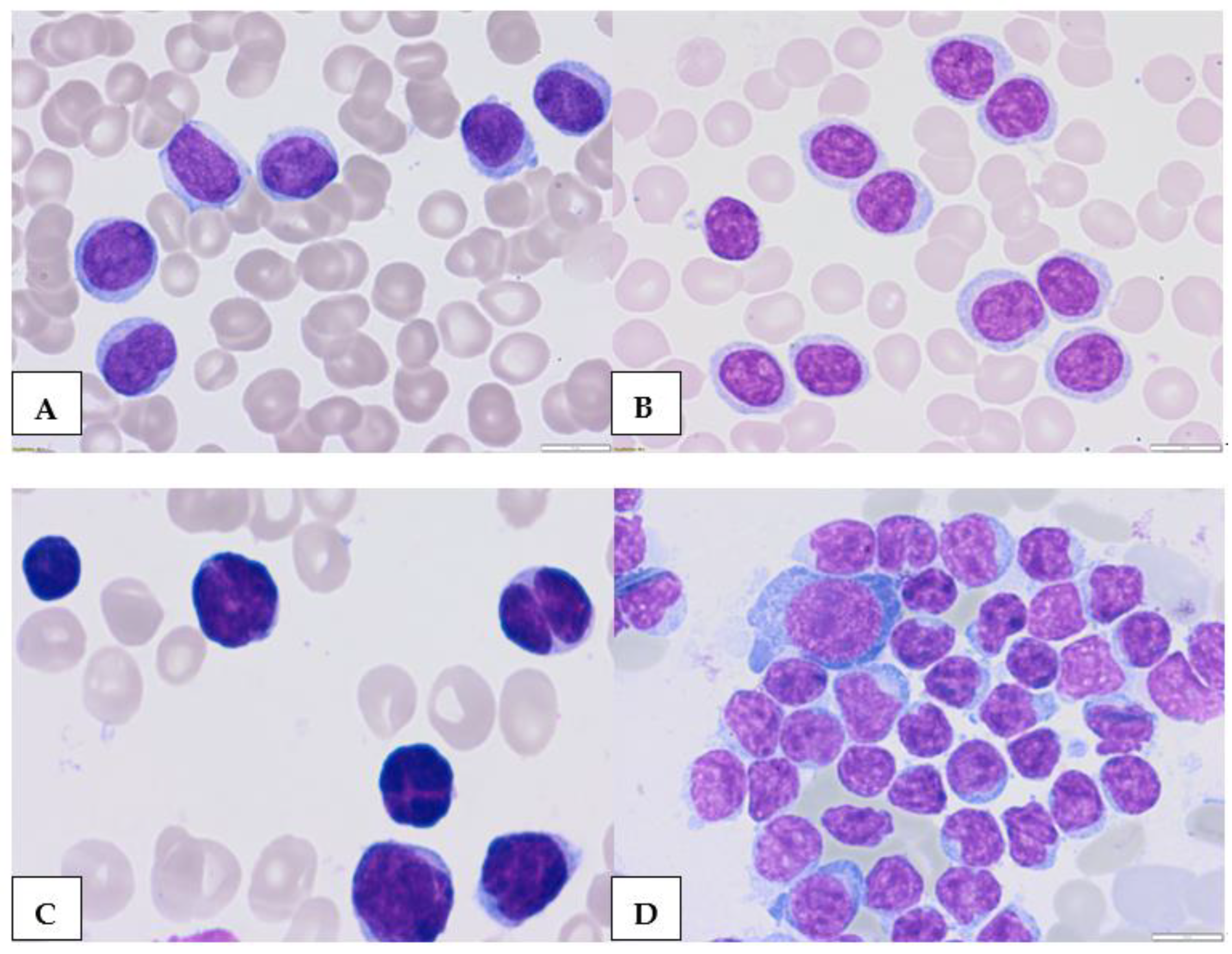 Atypical Chronic Lymphocytic Leukemia—The Current Status | MDPI