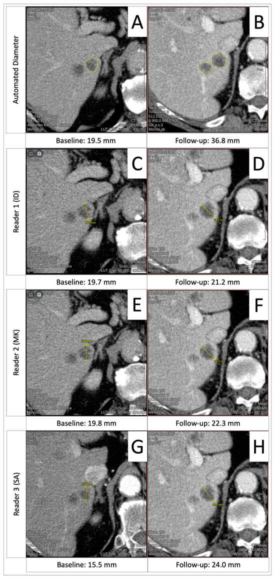 Recist Target Reliability of Automated RECIST 1.1 and Volumetric RECIST Target Lesion ...