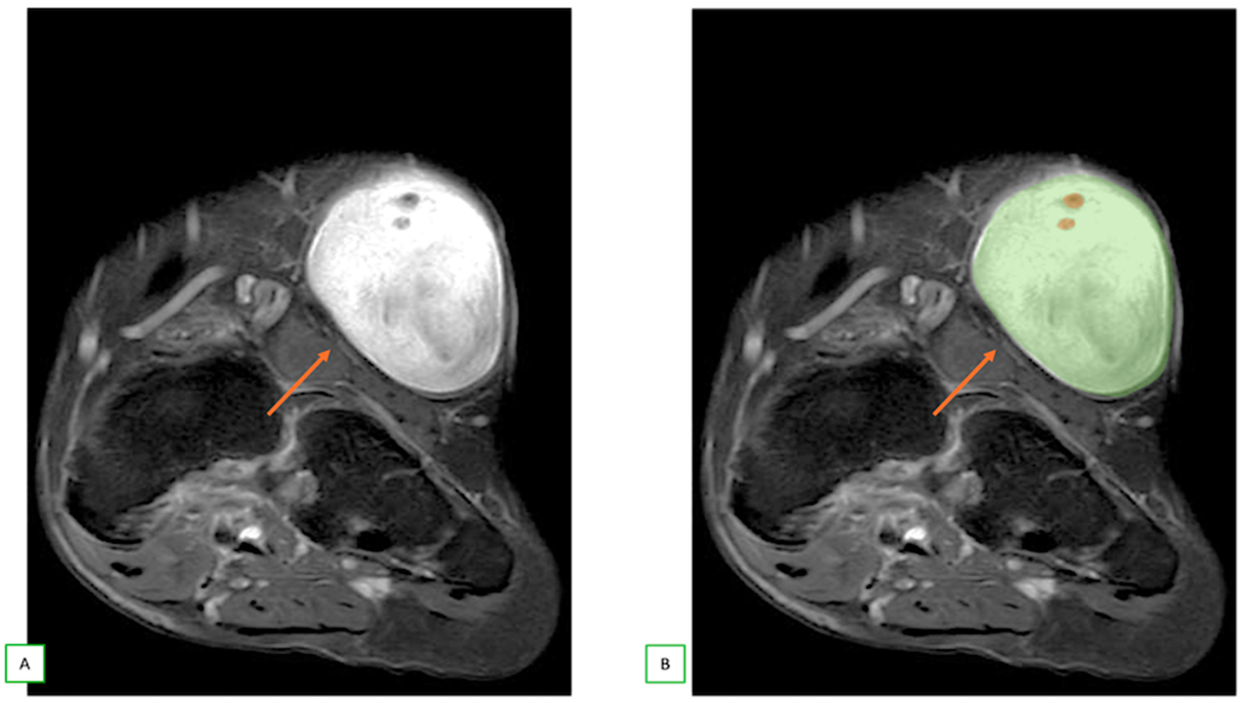 Cancers 17 00246 g006