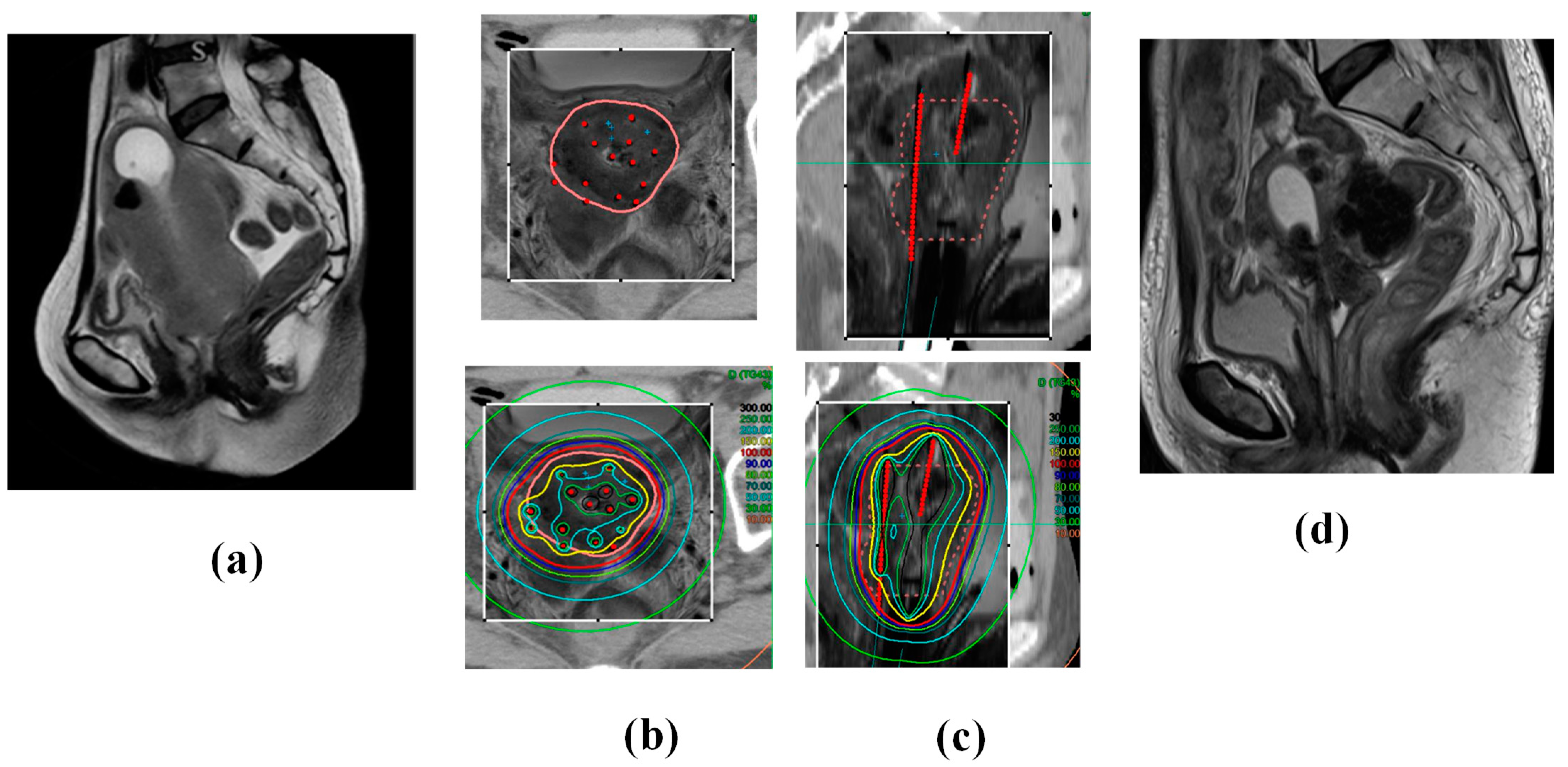 Cancers 17 00770 g004