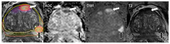 Cancers 17 00815 g003