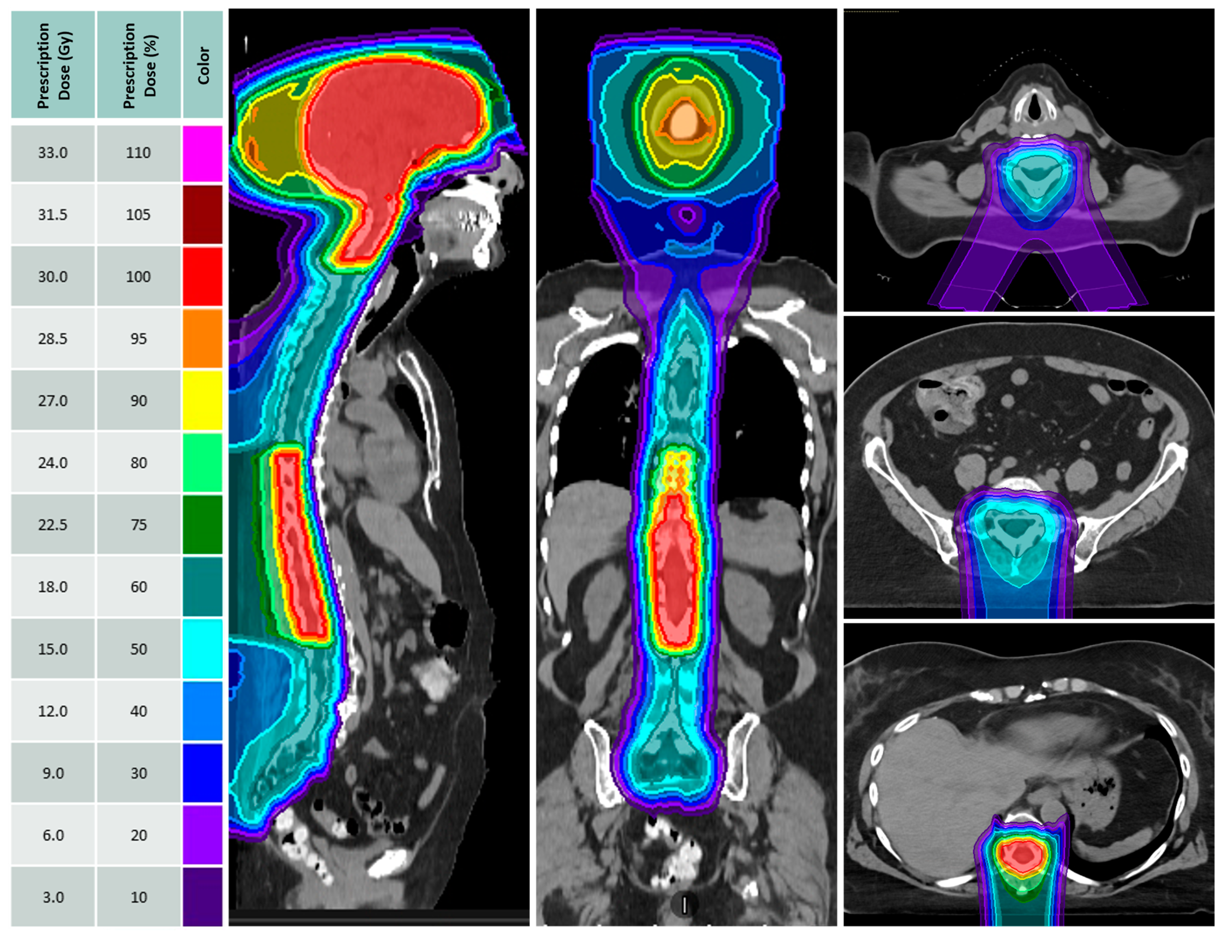 Proton Craniospinal Irradiation for Patients with Solid Tumor ...
