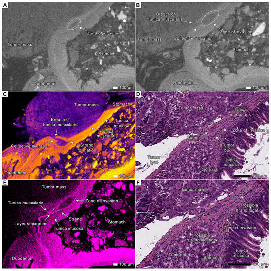 Cancers 17 01139 g011