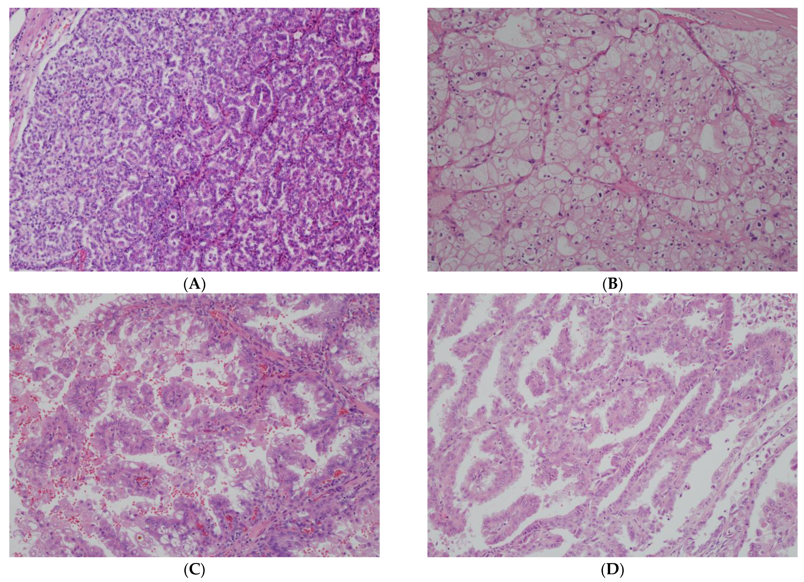 Systemic Treatment of Locally Advanced or Metastatic Non-Clear Cell ...