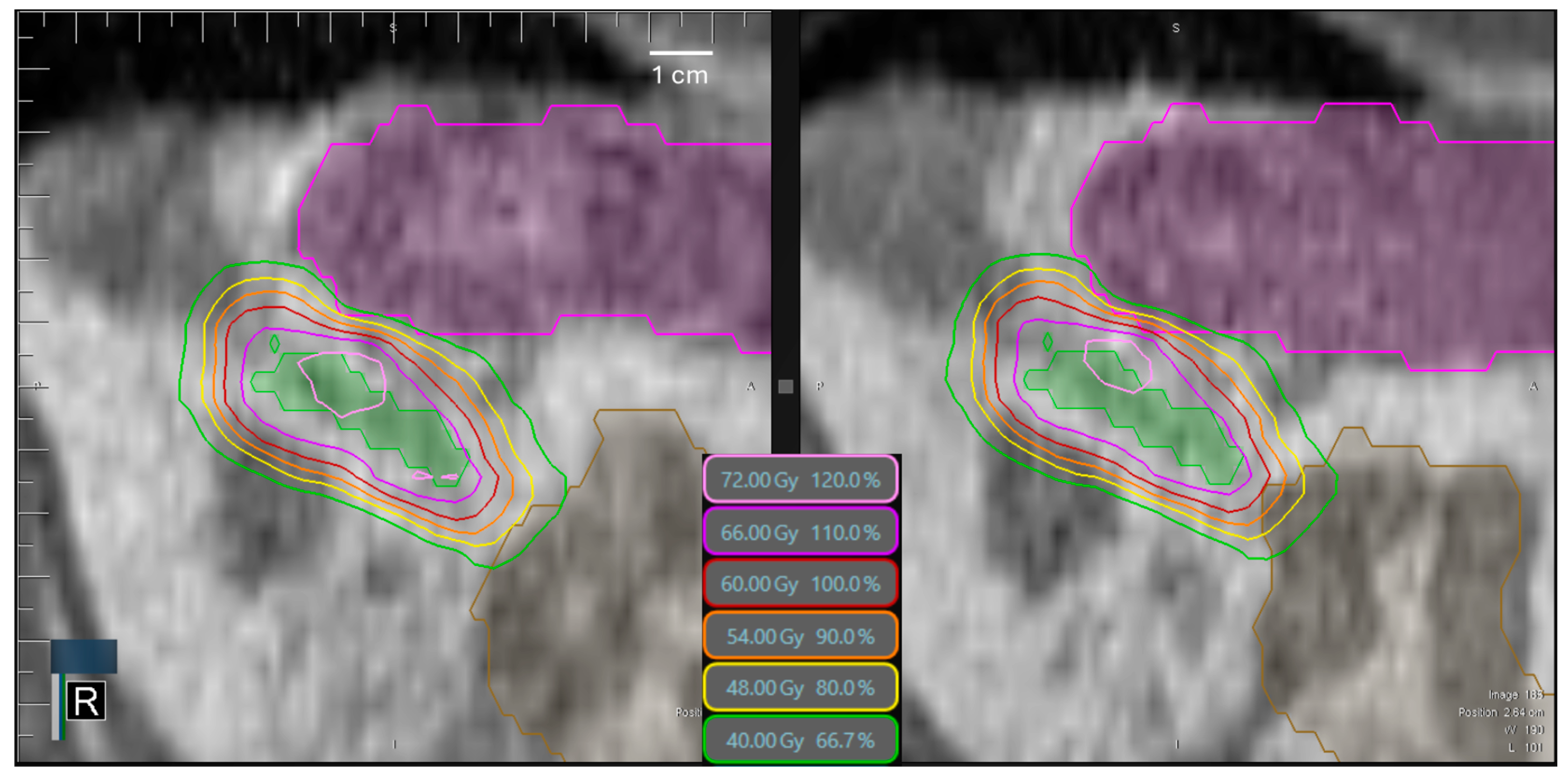 Cancers 17 01533 g005