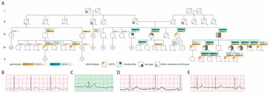 Pedigree and ECGs. (A) Pedigree, (B) ECG of patient carrying only KCNH2-p.L69P, (C) ECG of patient carrying only HCN4-p.R666W, (D) ECG of patient carrying both KCNH2-p.L69P and HCN4-p.R666W, (E) ECG of healthy family member. “?” indicates a patient with unknown phenotype.