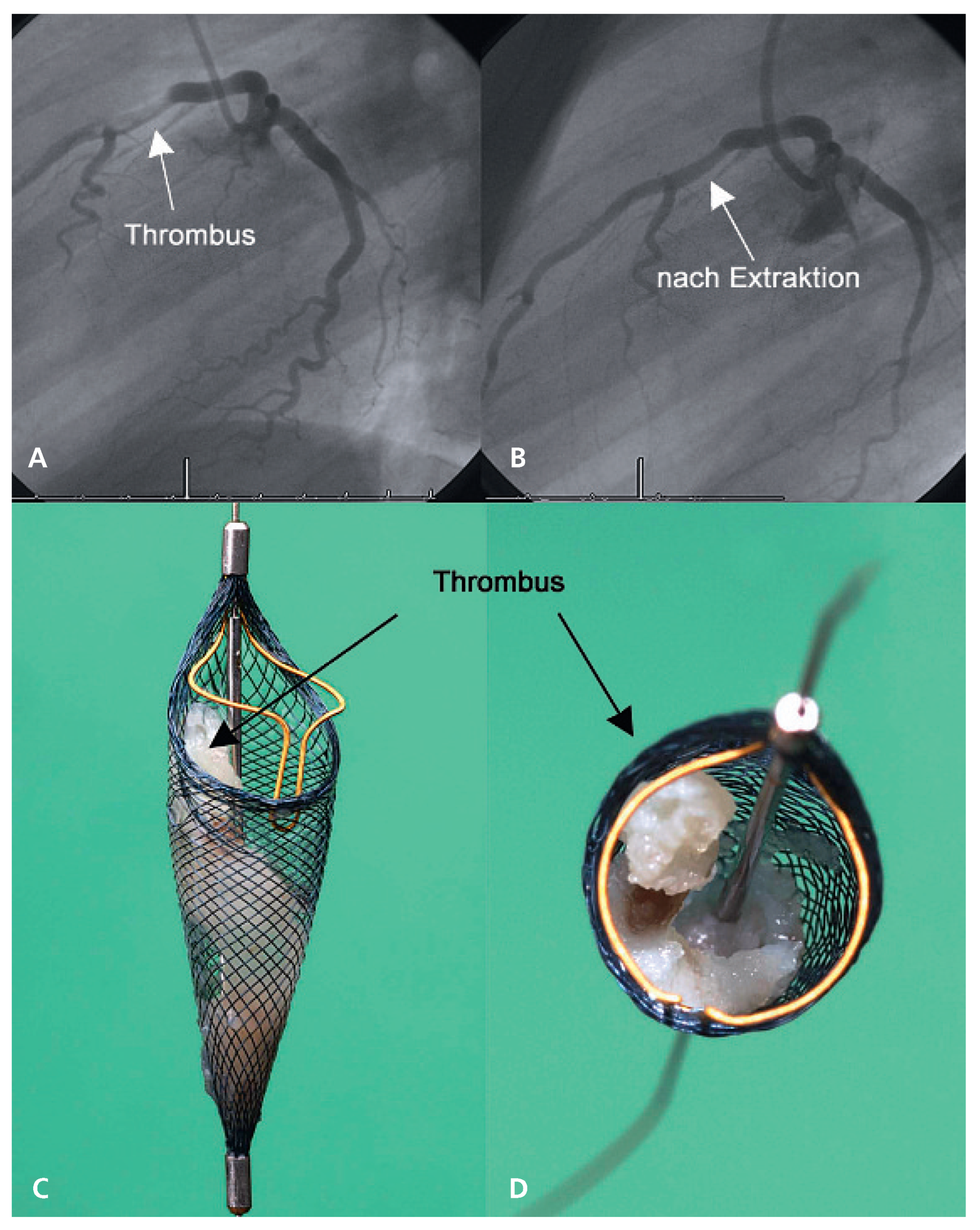 Cardiovascmed 12 00045 g002