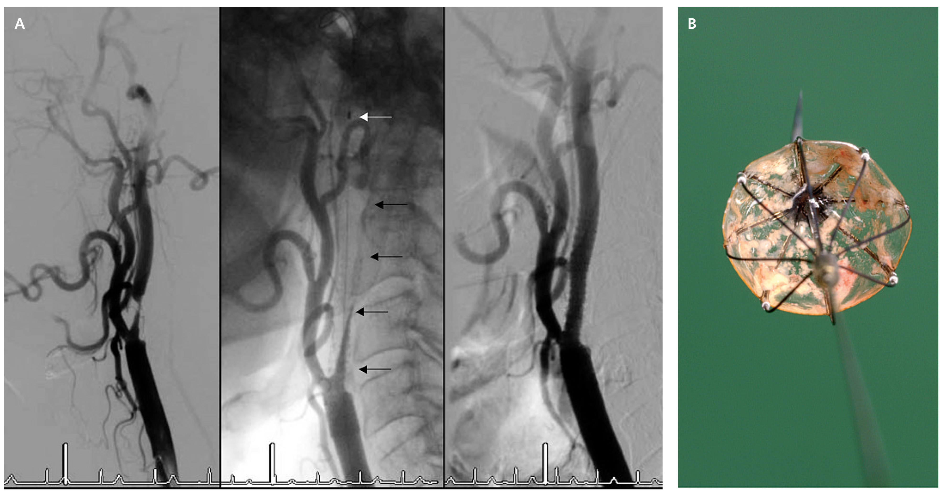 Cardiovascmed 12 00045 g005