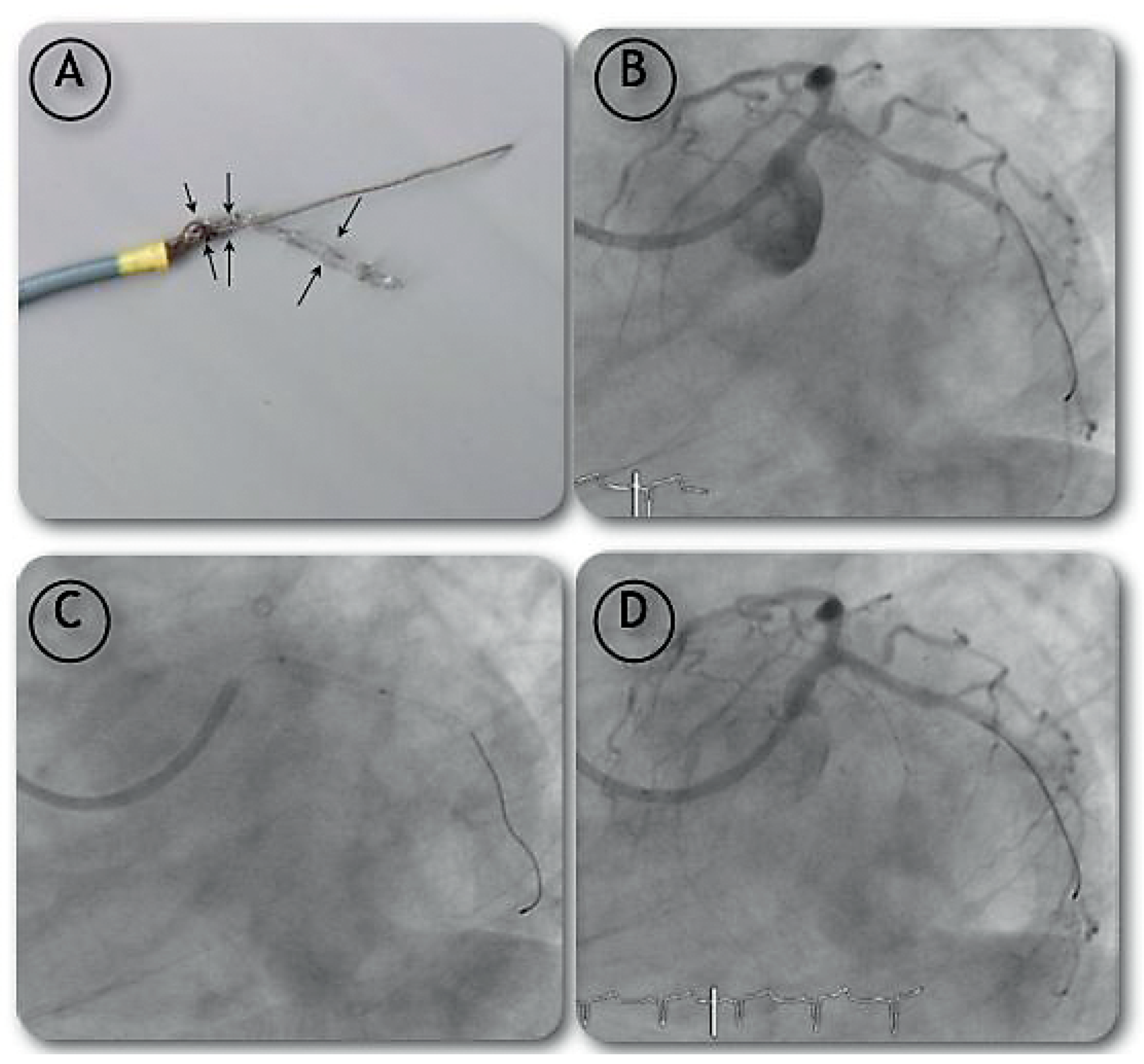 Cardiovascmed 12 00053 g004