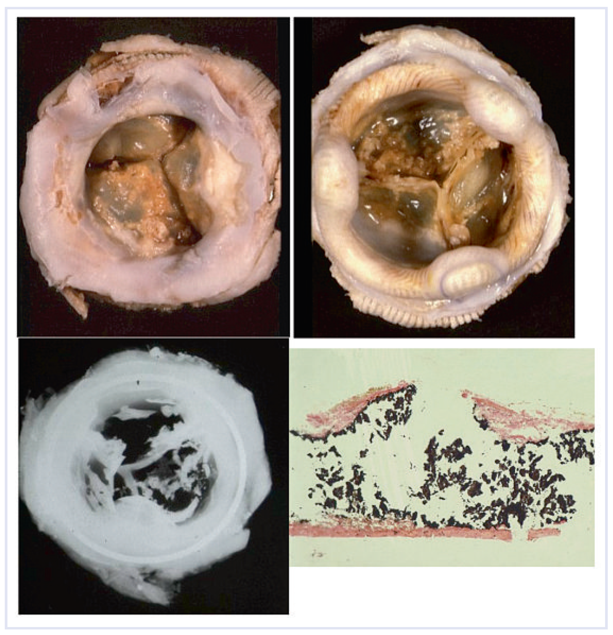 Cardiovascmed 13 00041 g004 Cardiovascmed 13 00041 g004