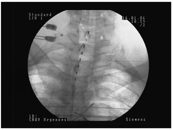 Cardiovascmed 13 00097 g002