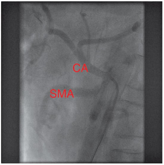 Cardiovascmed 13 00135 g004
