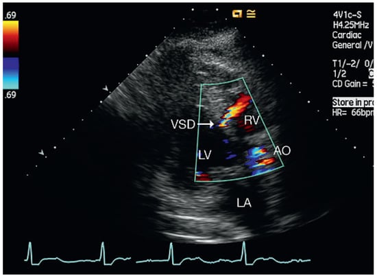 Cardiovascmed 13 00167 g003