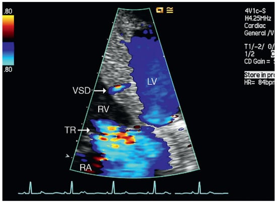 Cardiovascmed 13 00167 g004