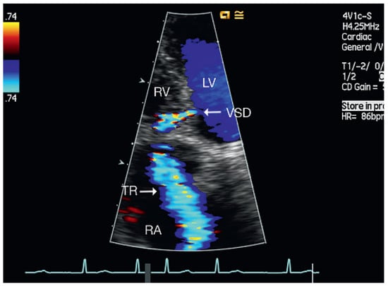 Cardiovascmed 13 00167 g005