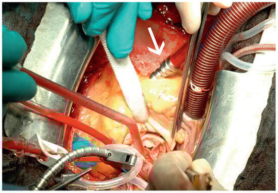 Cardiovascmed 13 00167 g008