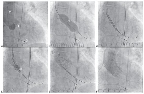 Cardiovascmed 13 00197 g004