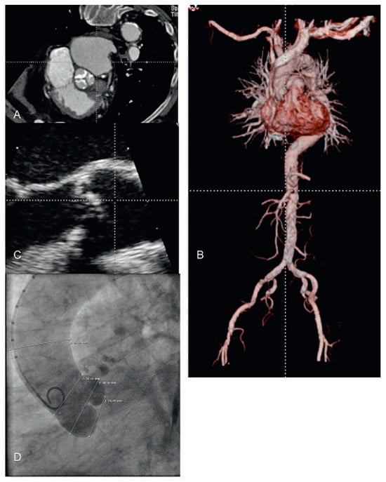 Cardiovascmed 13 00197 g007