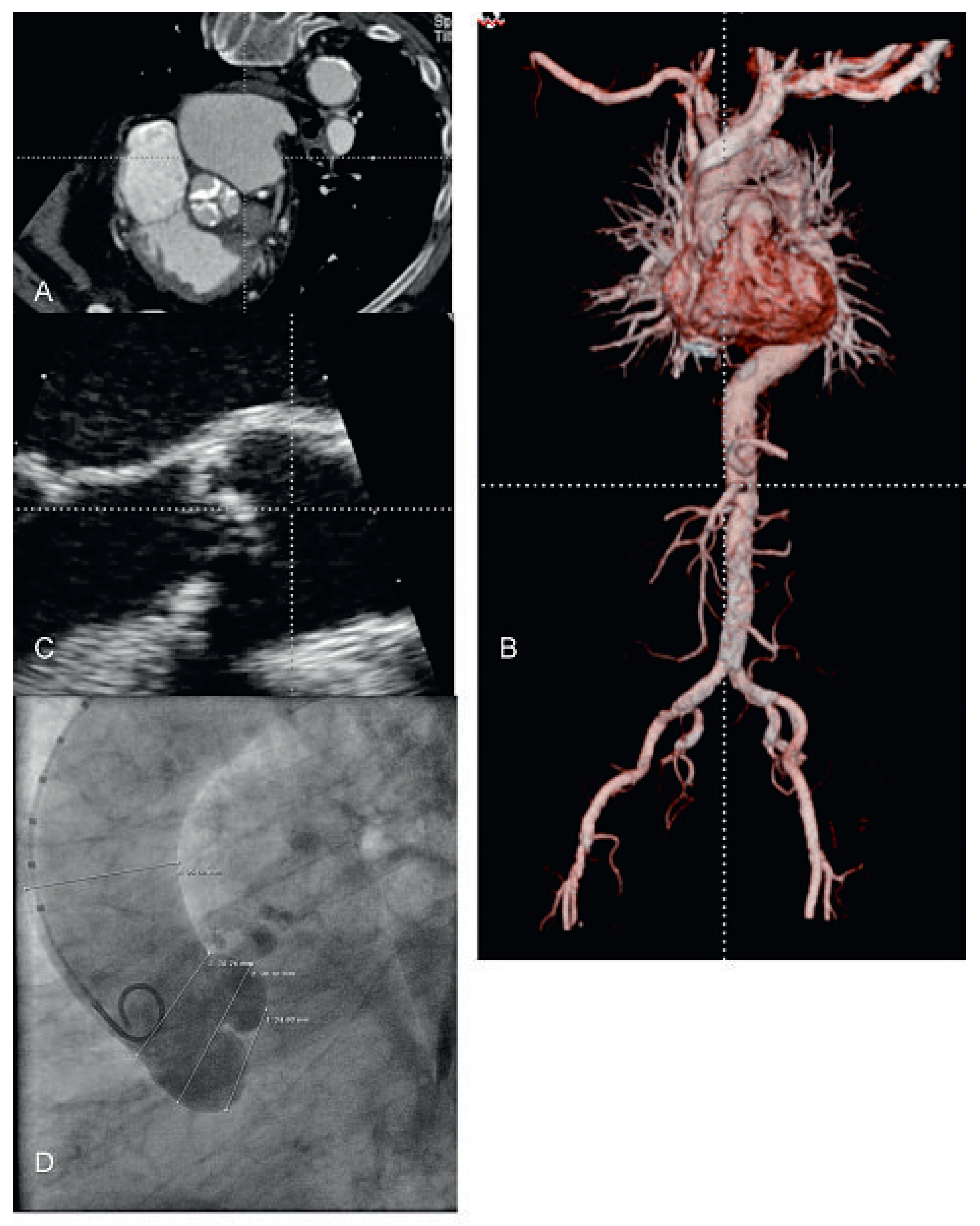 Cardiovascmed 13 00197 g007 Cardiovascmed 13 00197 g007