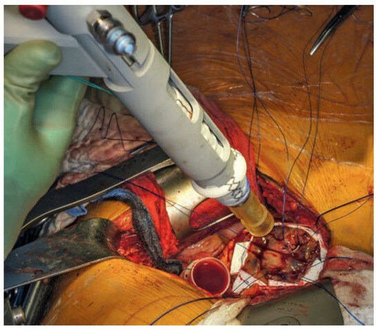 Cardiovascmed 17 00143 g003