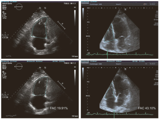 Cardiovascmed 20 00062 g005