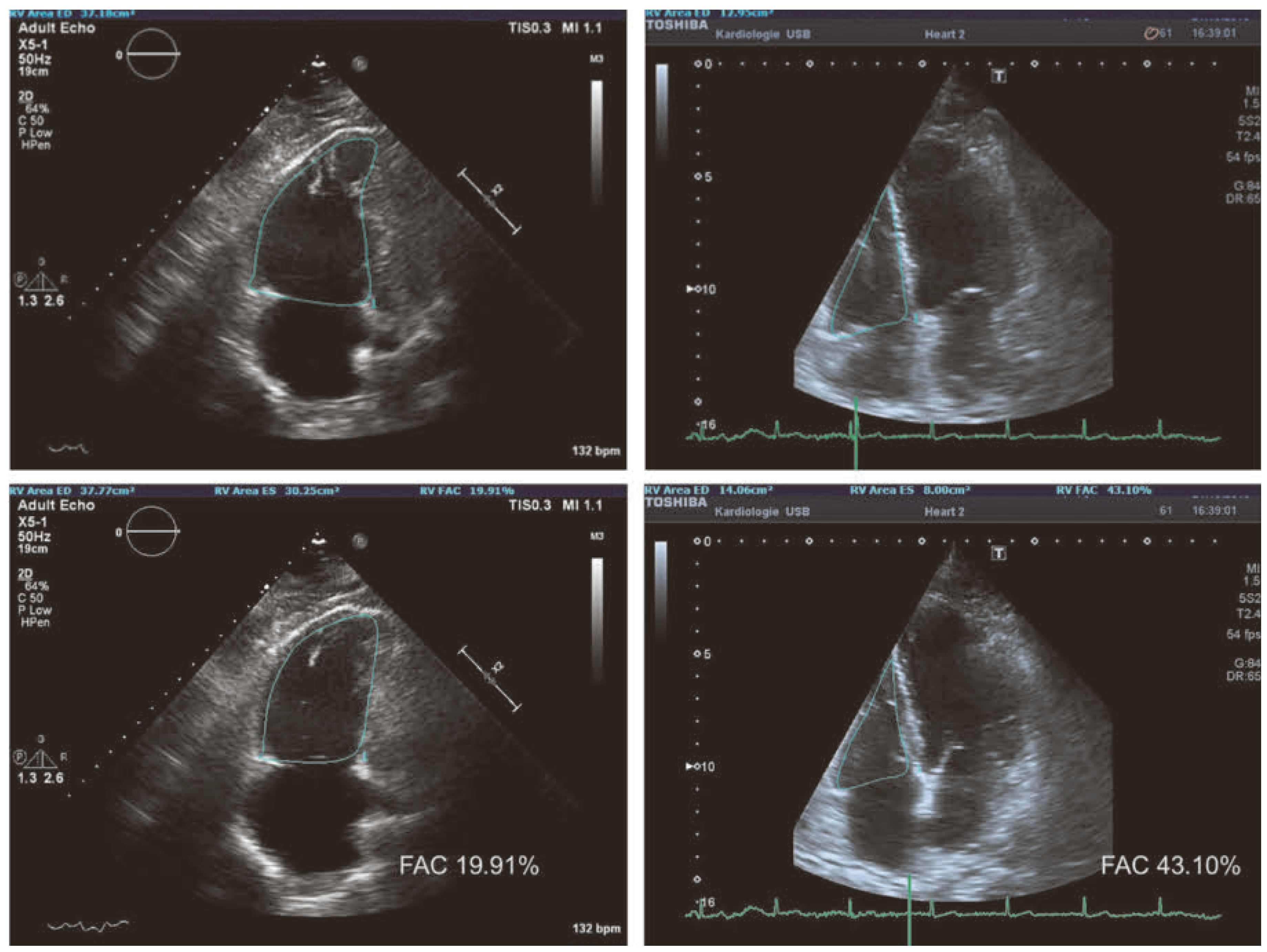 Cardiovascmed 20 00062 g005 Cardiovascmed 20 00062 g005