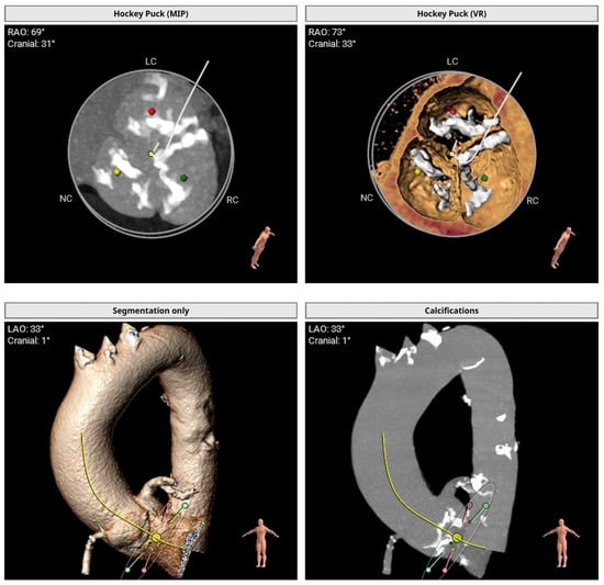 Preprocedural transcatheter aortic valve implantation computed tomography with 3D volume rendering showing calcium distribution in the aorta and aortic valve calcification. LAO: Left anterior oblique projection; LC: Left coronary; MIP: Maximum intensity projection; NC: Noncoronary; RAO: Right anterior oblique projection; RC: Right coronary; VR: Virtual reality.