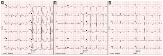 Time-Dependent ECG Modifications in Pheochromocytoma-Induced Cardiomyopathy. From left to right: (A) ECG on admission showing sinus tachycardia with anterolateral ST-segment elevation (arrows). (B) ECG obtained the following day after initiation of combined alpha- and beta-blockade therapy, demonstrating T-wave inversion (arrowheads) and significant QT interval prolongation (QT 520 ms, QTc 570 ms). (C) Postoperative ECG after adrenalectomy showing normalization of repolarization parameters (QT 430 ms, QTc 440 ms).