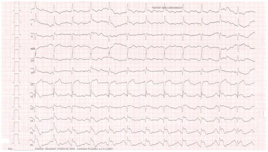 Initial 12-lead ECG on admission showing ST-segment elevation in leads V4–V6, fulfilling diagnostic criteria for anterolateral STEMI, in the absence of chest pain or other cardiopulmonary symptoms.