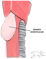 Schematic representation of the typical appearance of Zenker’s diverticulum. The diverticulum presents as a posterior outpouching of the mucosal and submucosal layers of the hypopharynx’s wall, protruding through Killian’s triangle, between the thyropharyngeal and cricopharyngeal parts of the inferior constrictor muscle of the pharynx. It typically extends posteriorly and inferiorly, lying between the cervical esophagus and the prevertebral fascia. Illustration by Diego Panci.