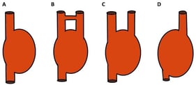 A schematic illustration of possible anatomical variants of the persistent superior vena cava [8]: (A) normal anatomical configuration with the right superior vena cava (RSVC); (B) presence of both RSVC and a persistent left superior vena cava (LSVC) connected by the left brachiocephalic vein (LBV); (C) double superior vena cava, similar to (B), but without the LBV; (D) persistent LSVC in the absence of the RSVC. Image: Prof. Schulze-Tanzil.
