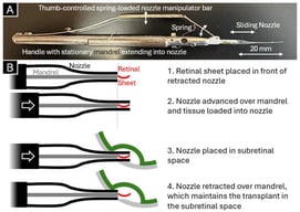 Manual injector (A,B) operating principles for transplanting sheets of retinal tissue into the subretinal space.